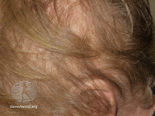 File:Anagen effluvium due to cranial irradiation (DermNet NZ hair-nails-sweat-anagen-effluvium-17).jpg