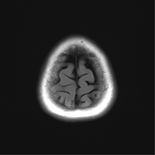 File:Anaplastic astrocytoma (Radiopaedia 86943-103160 Axial FLAIR 26).png