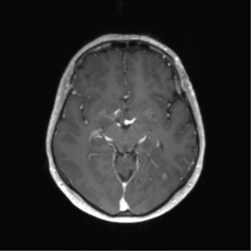 File:Anaplastic astrocytoma (Radiopaedia 86943-103160 Axial T1 C+ 18).png