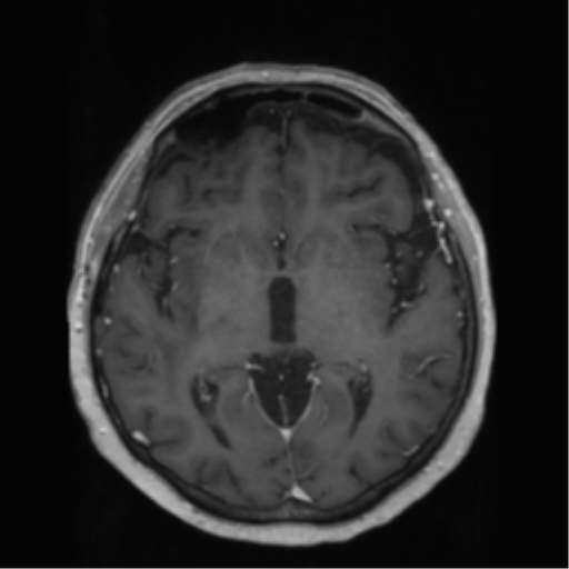 File:Anaplastic astrocytoma IDH wild-type (pseudoprogression) (Radiopaedia 42209-45278 Axial T1 C+ 78).png