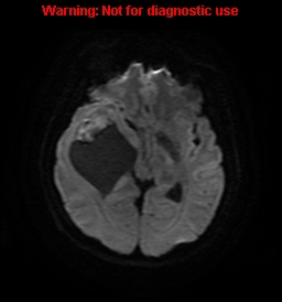 File:Anaplastic ganglioglioma (Radiopaedia 44921-48831 Axial DWI 13).jpg