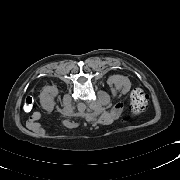 File:Anaplastic lymphoma - with CT biopsy (Radiopaedia 21643-21603 Axial non-contrast 5).jpg