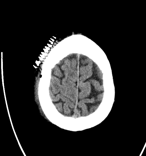 File:Anaplastic meningioma with recurrence (Radiopaedia 34452-35786 Axial non-contrast 28).png