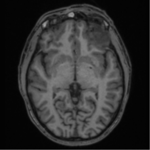 Anaplastic oligodendroglioma with skull fracture (Radiopaedia 74831-85845 Axial T1 29).png