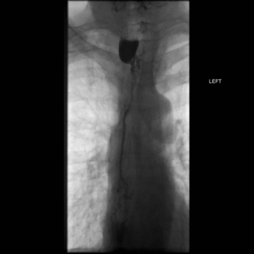 File:Anastomotic stricture post Ivor Lewis esophagectomy (Radiopaedia 47937-52715 B 25).png
