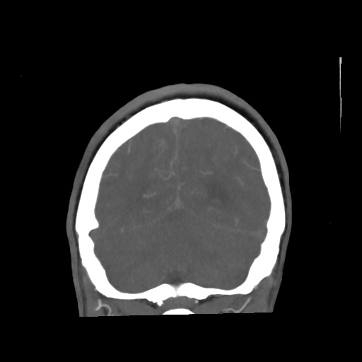 File:Aneursym related subarachnoid hemorrhage with hydrocephalus (Radiopaedia 45105-49084 B 67).jpg