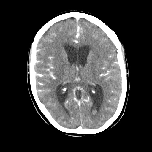 Aneursym related subarachnoid hemorrhage with hydrocephalus (Radiopaedia 45105-49084 D 29).jpg