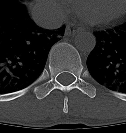 Aneurysmal bone cyst T11 (Radiopaedia 29294-29721 Axial bone window 31).jpg