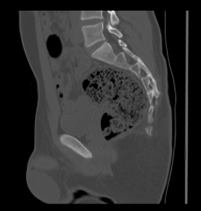 Aneurysmal bone cyst of ischium (Radiopaedia 25957-26094 Sagittal bone window 35).png