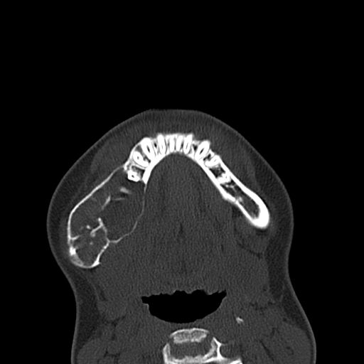 Aneurysmal bone cyst of the mandible (Radiopaedia 43280-46601 Axial bone window 16).jpg