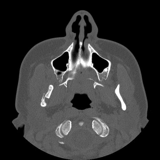 Aneurysmal bone cyst of the mandible (Radiopaedia 43280-46823 Axial bone window 104).jpg