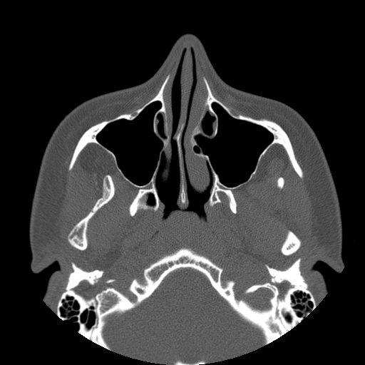 Aneurysmal bone cyst of the mandible (Radiopaedia 43280-46823 Axial bone window 128).jpg