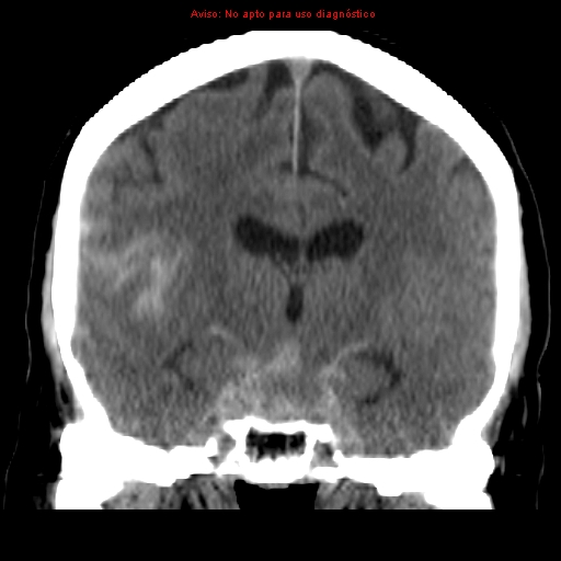 File:Aneurysmal subarachnoid hemorrhage (Radiopaedia 24740-24997 Coronal non-contrast 24).jpg