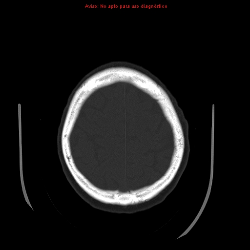 File:Aneurysmal subarachnoid hemorrhage (Radiopaedia 24740-24997 bone window 30).jpg