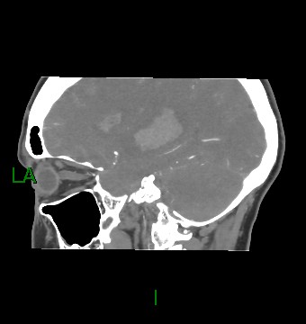 Aneurysmal subarachnoid hemorrhage with intra-axial extension (Radiopaedia 84371-99732 B 46).jpg
