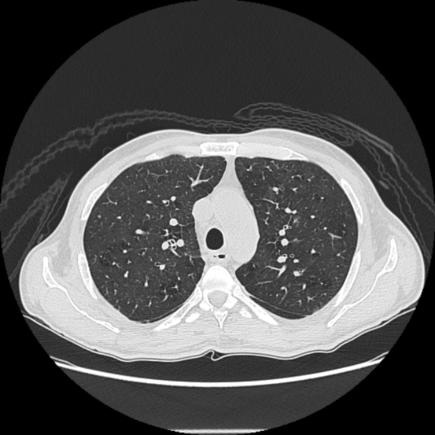 Angioinvasive aspergellosis (Radiopaedia 66995-76315 Axial lung window 15).jpg