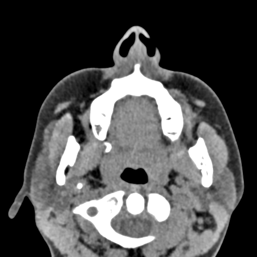 Angular dermoid cyst (Radiopaedia 88967-105790 Axial non-contrast 5).jpg