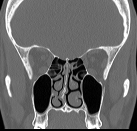 Angular epidermoid cyst (Radiopaedia 46908-51439 Coronal bone window 33).png
