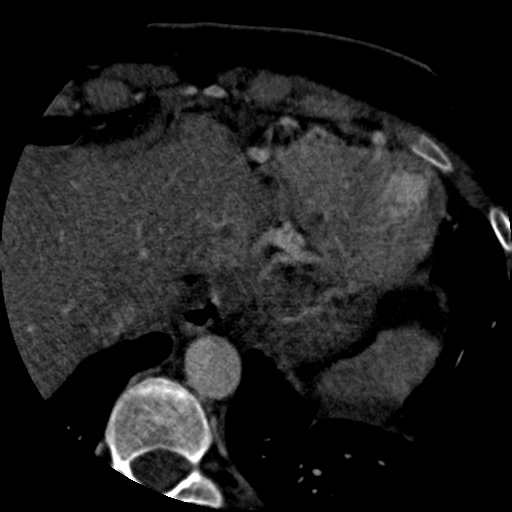 Anomalous left coronary artery from the pulmonary artery (ALCAPA) (Radiopaedia 40884-43586 A 79).jpg