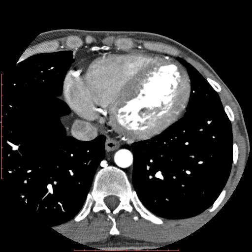 File:Anomalous left coronary artery from the pulmonary artery (ALCAPA) (Radiopaedia 70148-80181 A 289).jpg
