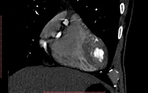 Anomalous left coronary artery from the pulmonary artery (ALCAPA) (Radiopaedia 70148-80181 B 70).jpg