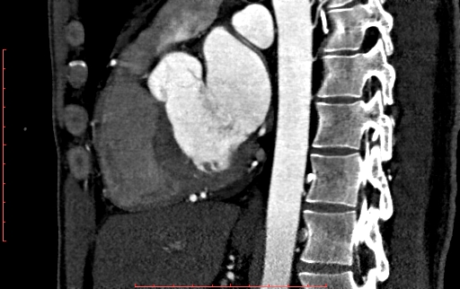 File:Anomalous left coronary artery from the pulmonary artery (ALCAPA) (Radiopaedia 70148-80181 C 129).jpg