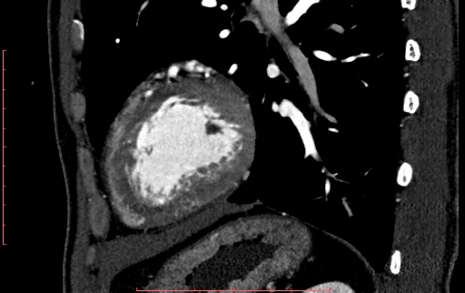 File:Anomalous left coronary artery from the pulmonary artery (ALCAPA) (Radiopaedia 70148-80181 C 196).jpg