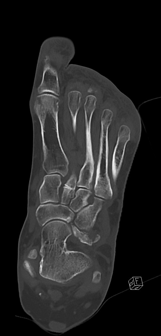 Anterior calcaneal process fracture (Radiopaedia 63353-71943 Coronal bone window 24).jpg