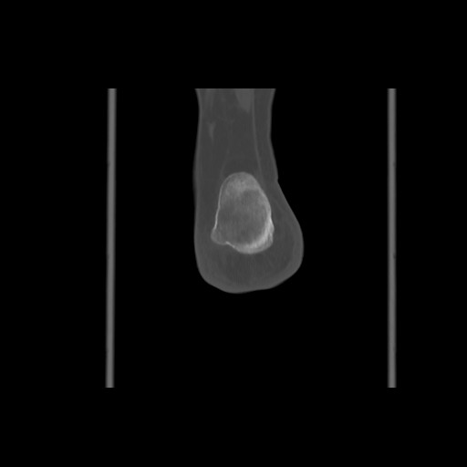 File:Anterior calcaneal process fracture (Radiopaedia 82590-96762 Coronal bone window 71).jpg