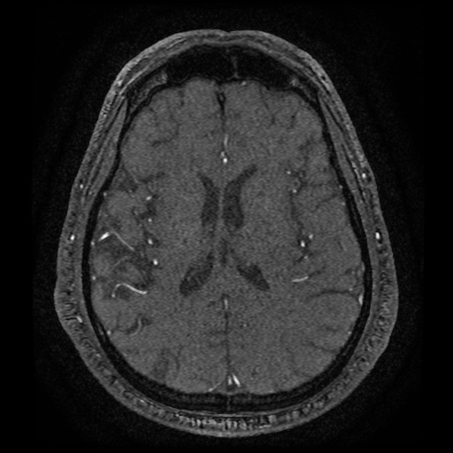 Anterior cerebral artery infarction (Radiopaedia 46794-51323 Axial MRA 130).jpg