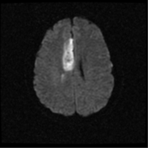 File:Anterior cerebral artery territory infarct (Radiopaedia 39327-41584 Axial DWI 17).png