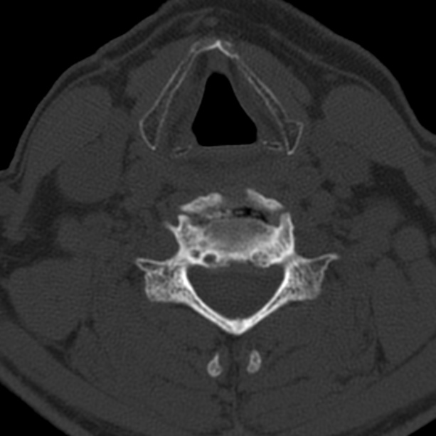 Anterior cervical postdiscectomy arthrodesis (Radiopaedia 32678-33646 Axial bone window 48).jpg
