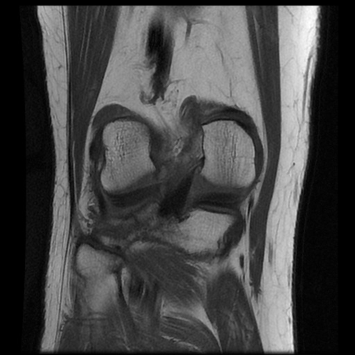 File:Anterior cruciate ligament avulsion fracture (Radiopaedia 58939-66193 Coronal T1 14).jpg