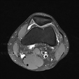 File:Anterior cruciate ligament full thickness tear (Radiopaedia 66268-75467 Axial PD fat sat 8).jpg