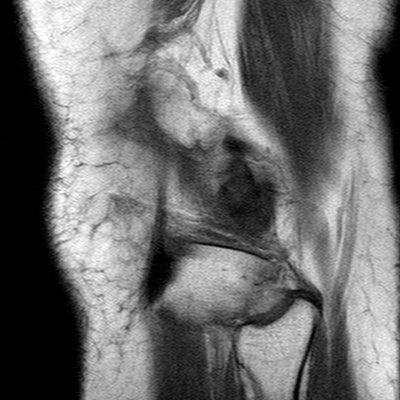 Anterior cruciate ligament mucoid degeneration (Radiopaedia 60853-68633 Sagittal T1 53).jpg