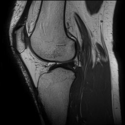 Anterior cruciate ligament rupture and posteromedial corner injury (Radiopaedia 67338-76723 Sagittal PD 103).jpg