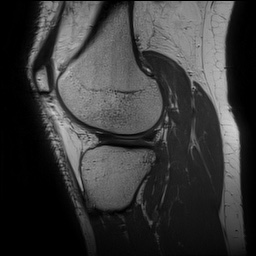 Anterior cruciate ligament rupture and posteromedial corner injury (Radiopaedia 67338-76723 Sagittal PD 120).jpg