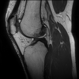 Anterior cruciate ligament rupture and posteromedial corner injury (Radiopaedia 67338-76723 Sagittal PD 95).jpg