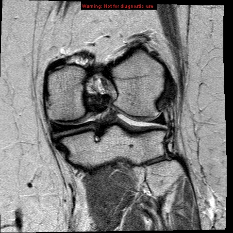 File:Anterior cruciate ligament tear (Radiopaedia 12329-12612 Coronal PD 15).jpg