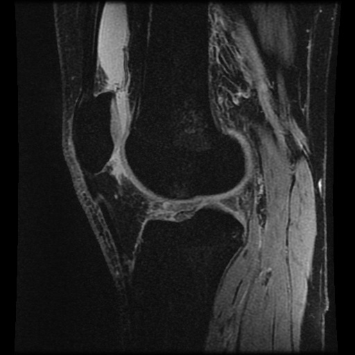 Anterior cruciate ligament tear (Radiopaedia 61500-69462 F 54).jpg