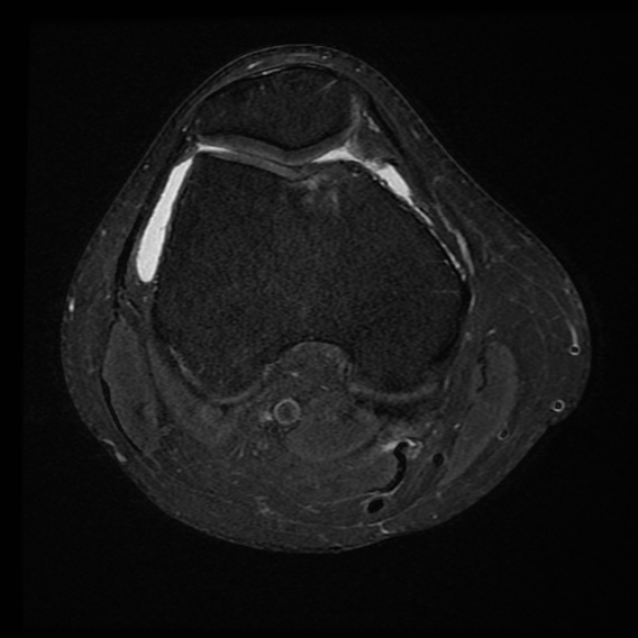 File:Anterior cruciate ligament tear with posteromedial corner injury, bucket-handle meniscal tear and chondral delamination (Radiopaedia 75501-86744 Axial PD fat sat 18).jpg