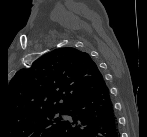 Anterior glenohumeral dislocation with Hill-Sachs lesion (Radiopaedia 62877-71249 Sagittal bone window 63).jpg