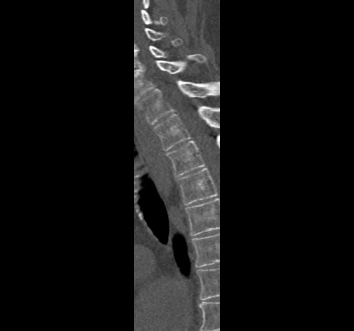 Anterior glenohumeral dislocation with Hill-Sachs lesion (Radiopaedia 62877-71249 Sagittal bone window 85).jpg