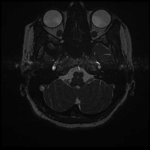 Anterior inferior cerebellar artery vascular loop - type II (Radiopaedia 70991-81209 Axial 3D FIESTA 61).jpg