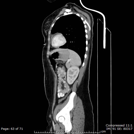 File:Anterior mediastinal B cell Lymphoma (Radiopaedia 50677-56114 C 32).jpg