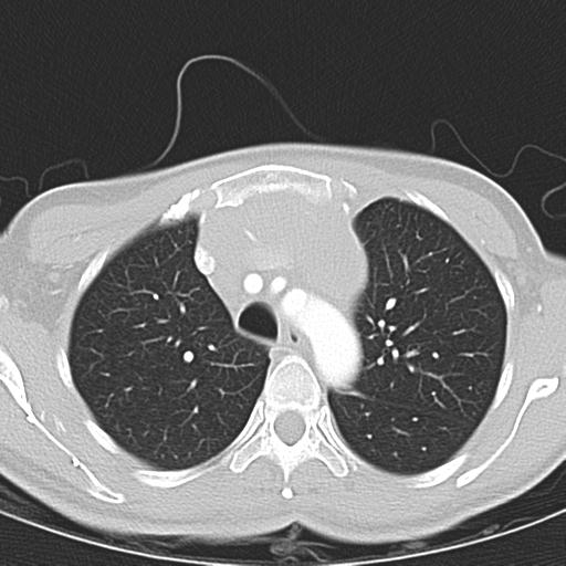 Anterior mediastinal lymphoma (Radiopaedia 29556-30061 Axial lung window 15).jpg
