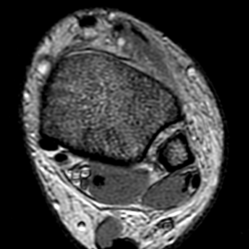 File:Anterior talofibular ligament rupture (Radiopaedia 15831-15484 Axial T2* 2).jpg