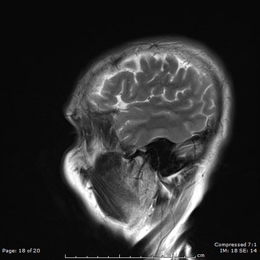File:Anterior temporal lobe perivascular space (Radiopaedia 88283-104914 Sagittal T2 18).jpg