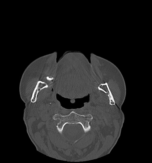 Anterior temporomandibular joint dislocation (Radiopaedia 59430-66784 Axial non-contrast 37).jpg