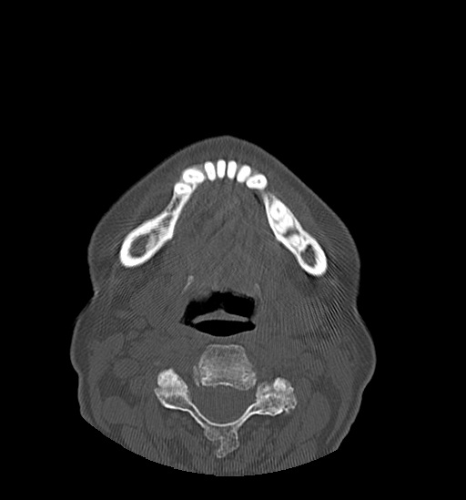 Anterior temporomandibular joint dislocation (Radiopaedia 59430-66784 Axial non-contrast 49).jpg